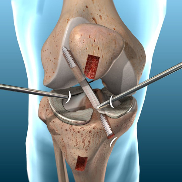 ligaments Surgery