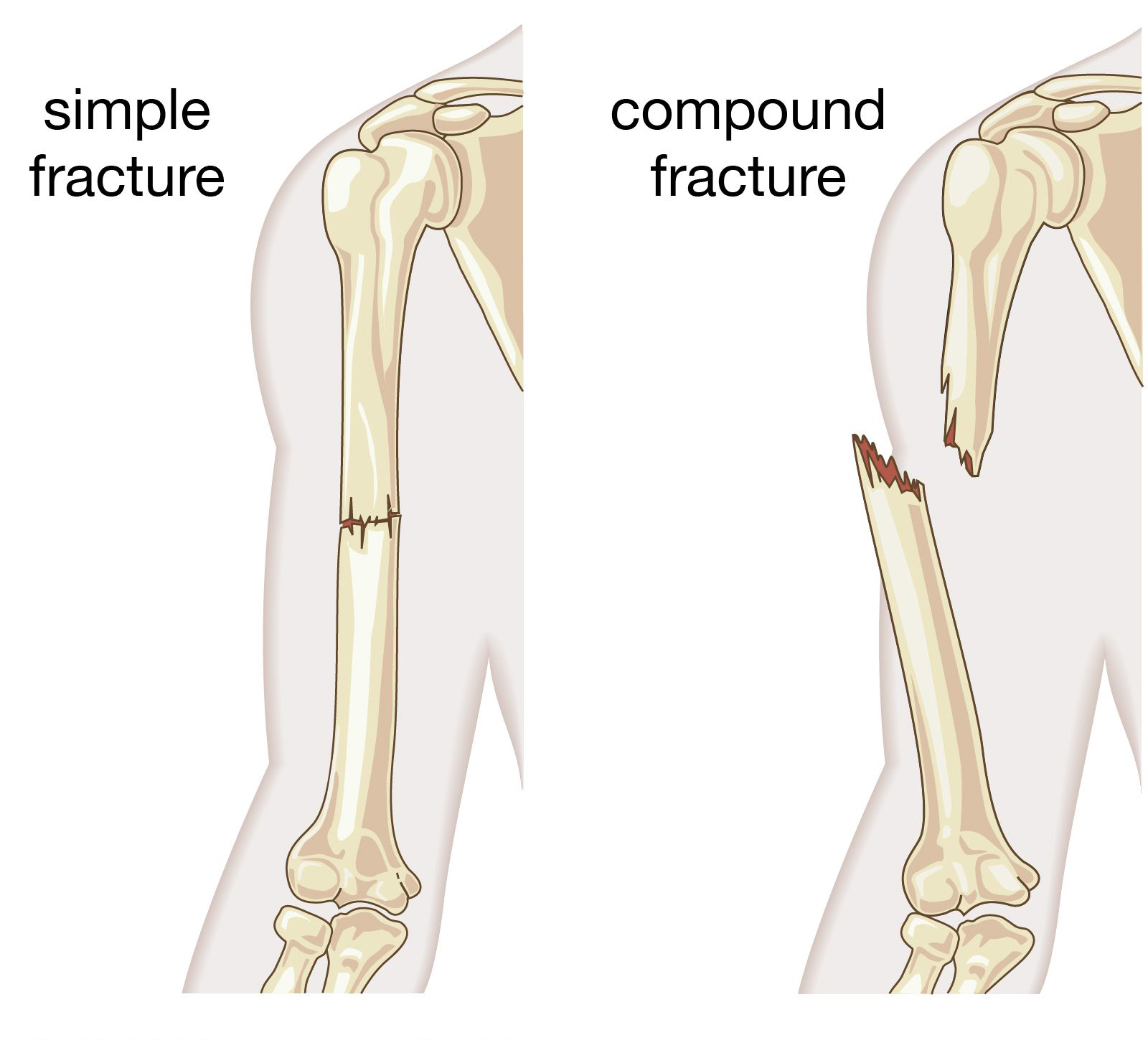 Fractures Details